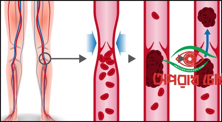 সমস্যার নাম থ্রম্বোসিস